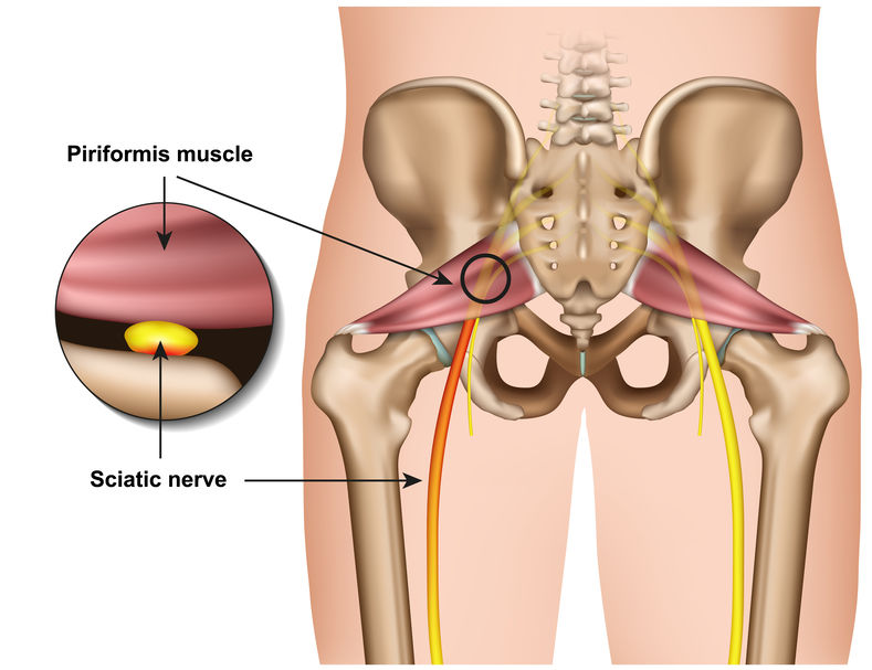 How Chiropractic Treatment Helps Sciatica & Five Other Disorders That May Surprise You